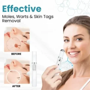 ODALIT™ Non-Invasive Mole and Wart Removal Laser Pen