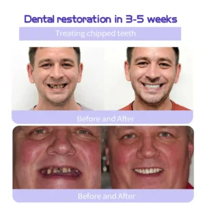🎁Flash Sale - Don’t Miss Out - ODALIT™ TeethRestoration Mineral Powder🦷(ADA recommended)👩⚕️(Treats periodontitis and mouth ulcers, prevents tooth loss, and repairs gum recession)
