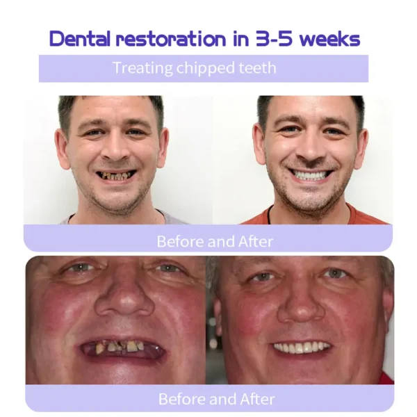 🎁Flash Sale - Don’t Miss Out - ODALIT™ TeethRestoration Mineral Powder🦷(ADA recommended)👩‍⚕️(Treats periodontitis and mouth ulcers, prevents tooth loss, and repairs gum recession)