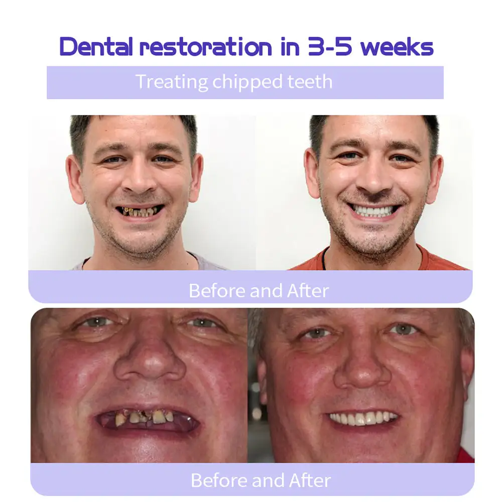 🎁Flash Sale - Don’t Miss Out - ODALIT™ TeethRestoration Mineral Powder🦷(ADA recommended)👩⚕️(Treats periodontitis and mouth ulcers, prevents tooth loss, and repairs gum recession)
