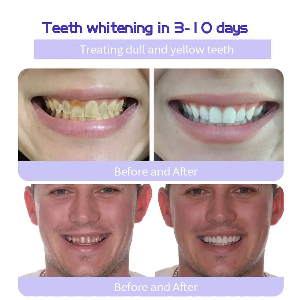 🎁Flash Sale - Don’t Miss Out - ODALIT™ TeethRestoration Mineral Powder🦷(ADA recommended)👩⚕️(Treats periodontitis and mouth ulcers, prevents tooth loss, and repairs gum recession)