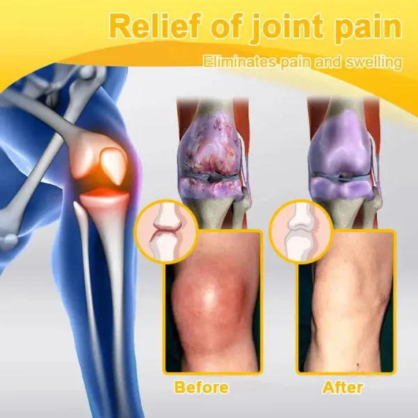 🎁Flash Sale - ODALIT™ Botulinum Toxin & Bee Venom Pain-Relief Bone Healing Cream🐝💎